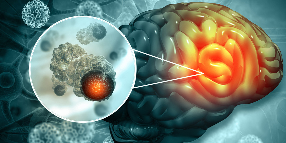 Brain And Spine Tumour Best Treatment In Thane West