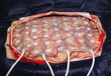 Epilepsy Surgery In Thane