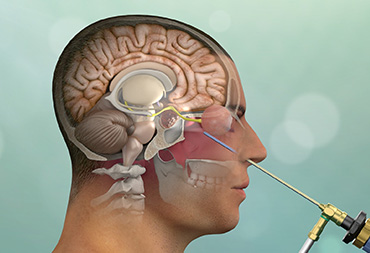 Neuroendoscopi And Skull Base Surgery In Thane