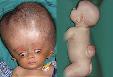 Pediatric Neurosurgery In Thane