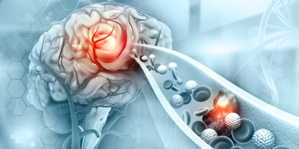 Vascular Neurosurgery Best Treatment In Thane West