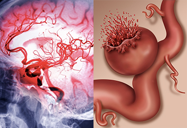 Vascular Neurosurgery In Thane